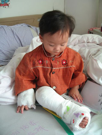 Child with club foot